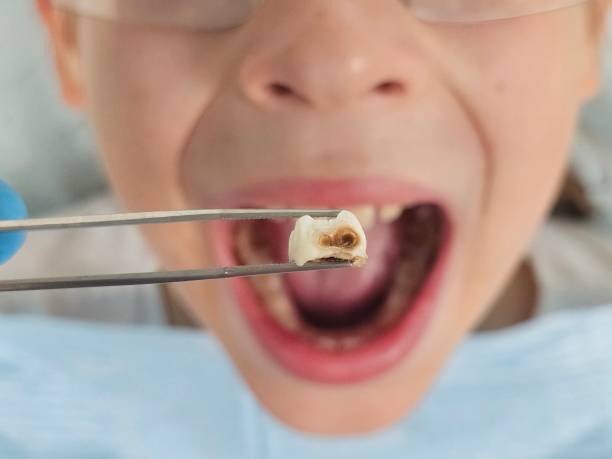 Best Emergency Treatment for Dental Infections or Abscesses in Dland, MI