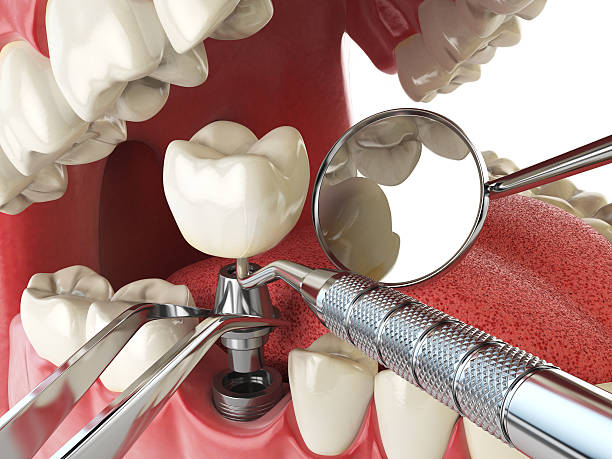 Best Emergency Tooth Extraction in Dland, MI